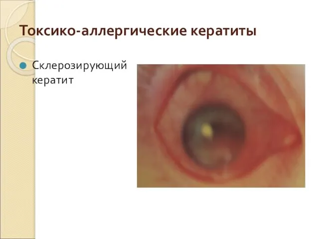 Токсико-аллергические кератиты Склерозирующий кератит