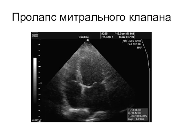 Пролапс митрального клапана