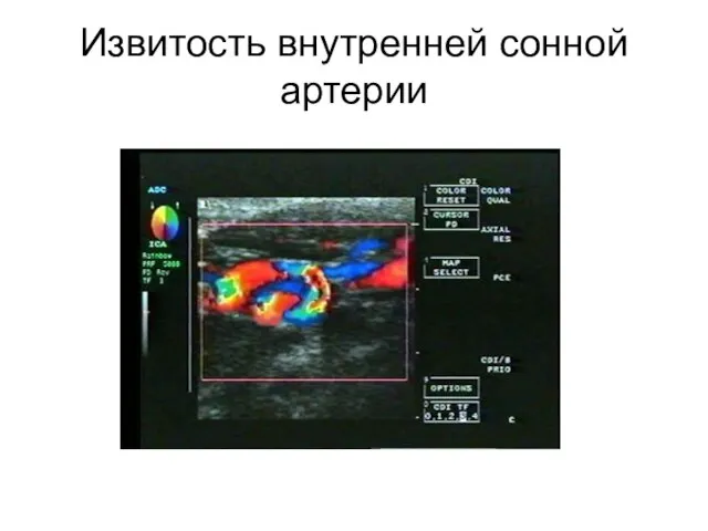 Извитость внутренней сонной артерии