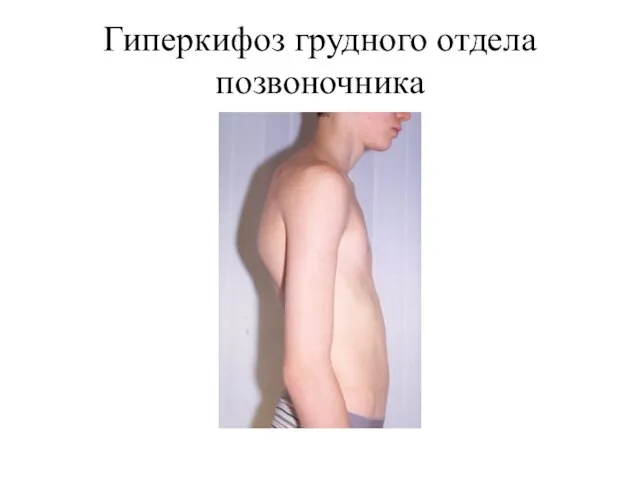 Гиперкифоз грудного отдела позвоночника