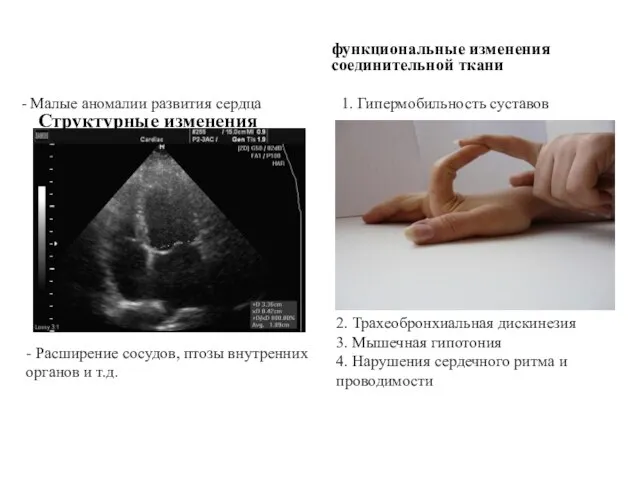 Структурные изменения соединительной ткани функциональные изменения соединительной ткани - Малые аномалии