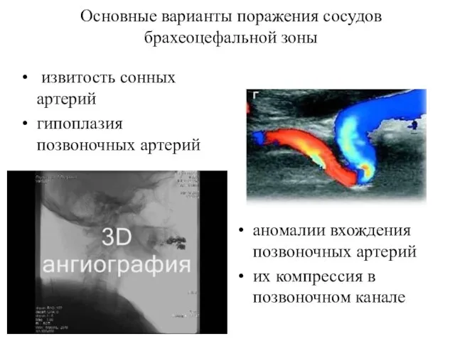 Основные варианты поражения сосудов брахеоцефальной зоны извитость сонных артерий гипоплазия позвоночных