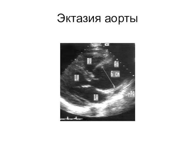 Эктазия аорты