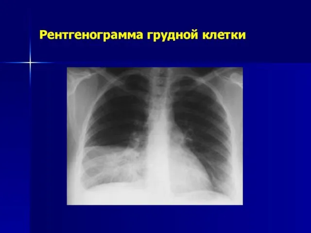 Рентгенограмма грудной клетки