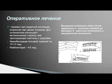 показано при неудачной репозиции, вторичном сме щении отломков. Для остеосинтеза используют