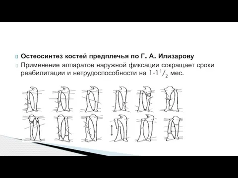 Остеосинтез костей предплечья по Г. А. Илизарову Применение аппаратов наружной фиксации