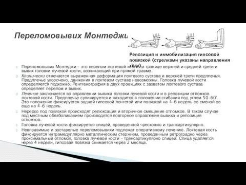 Переломовывих Монтеджи – это перелом локтевой кости на границе верхней и