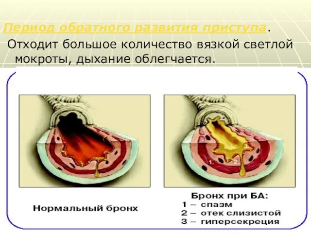 Период обратного развития приступа. Отходит большое количество вязкой светлой мокроты, дыхание облегчается.