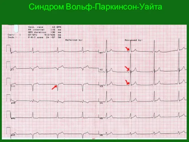 Синдром Вольф-Паркинсон-Уайта