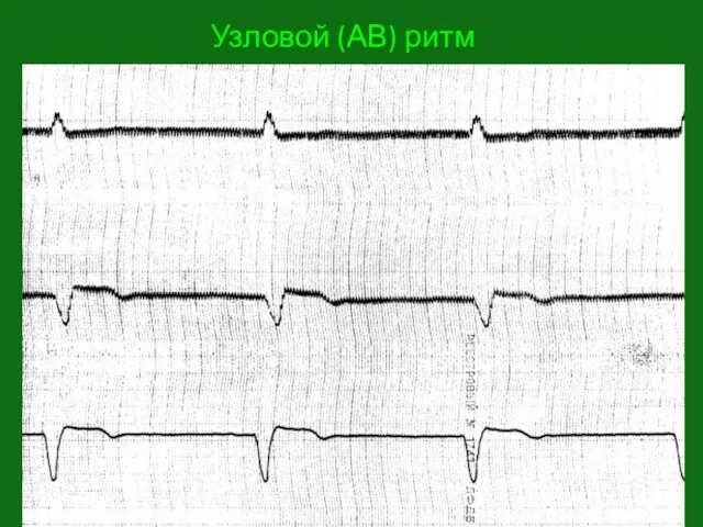 Узловой (АВ) ритм