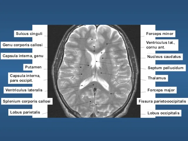 Sulcus cinguli Genu corporis callosi Capsula interna, genu Putamen Capsula interna,