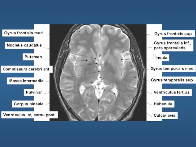Gyrus frontalis med. Nucleus caudatus Putamen Commissura cerebri ant. Massa intermedia