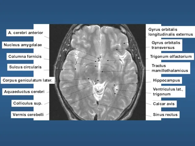 A. cerebri anterior Nucleus amygdalae Columna fornicis Sulcus circularis Corpus geniculatum