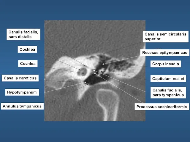 Canalis facialis, pars distalis Cochlea Cochlea Canalis caroticus Hypotympanum Annulus tympanicus