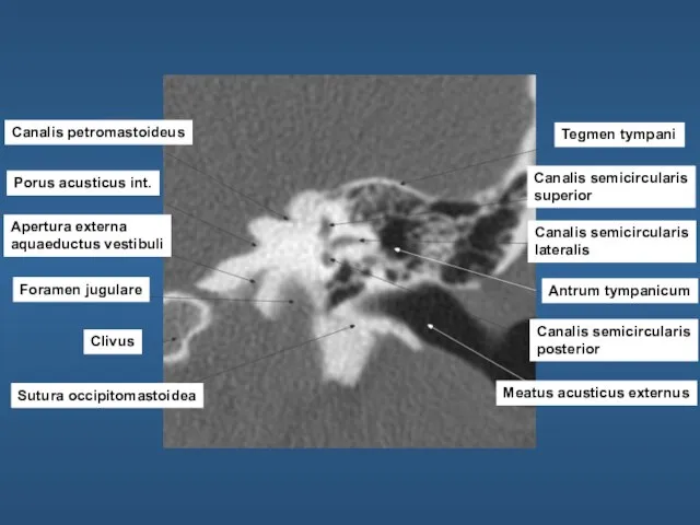 Canalis petromastoideus Porus acusticus int. Apertura externa aquaeductus vestibuli Foramen jugulare