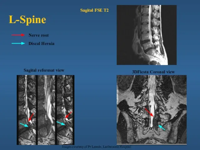 L-Spine 3DFiesta Coronal view Sagital FSE T2 Nerve root Discal Hernia