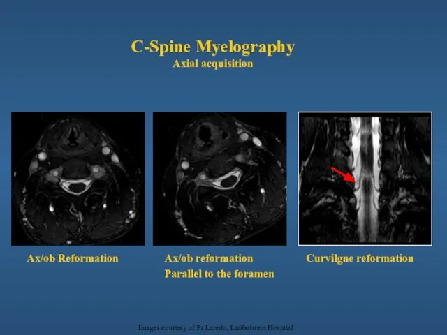 C-Spine Myelography Axial acquisition Ax/ob Reformation Curvilgne reformation Ax/ob reformation Parallel