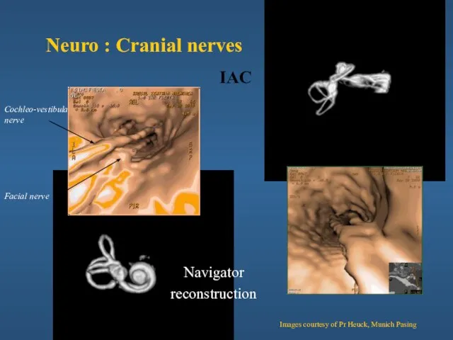 IAC Cochleo-vestibular nerve Facial nerve Neuro : Cranial nerves Navigator reconstruction