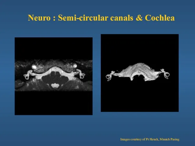 MIP Neuro : Semi-circular canals & Cochlea Images courtesy of Pr Heuck, Munich Pasing Volume Rendering