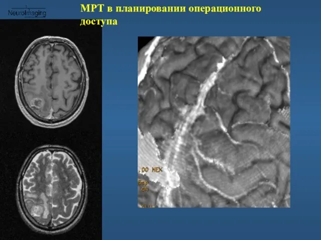 МРТ в планировании операционного доступа