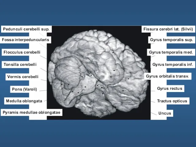 Pedunculi cerebelli sup. Fossa interpeduncularis Flocculus cerebelli Tonsilla cerebelli Vermis cerebelli