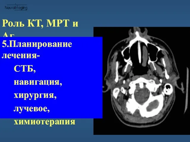 Роль КТ, МРТ и Аг 5.Планирование лечения- СТБ, навигация, хирургия, лучевое, химиотерапия