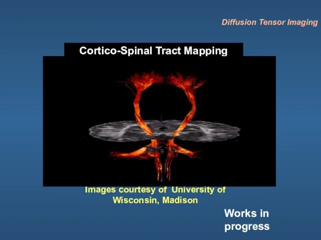 Cortico-Spinal Tract Mapping Images courtesy of University of Wisconsin, Madison Diffusion Tensor Imaging Works in progress