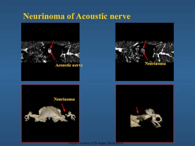 Neurinoma Facial nerve Facial nerve Acoustic nerve Neurinoma Neurinoma Images courtesy