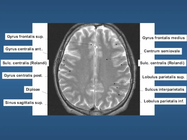 Gyrus frontalis sup. Gyrus centralis ant.. Sulc. centralis (Rolandi) Gyrus centralis