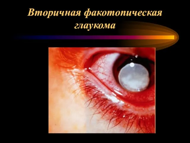 Вторичная факотопическая глаукома