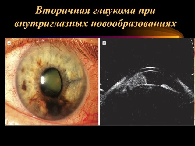 Вторичная глаукома при внутриглазных новообразованиях