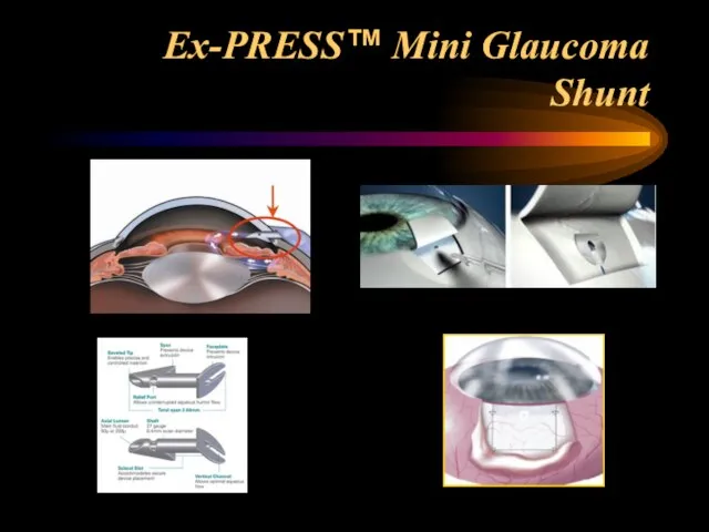 Ex-PRESS™ Mini Glaucoma Shunt