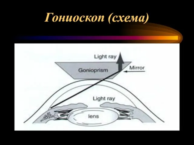 Гониоскоп (схема)