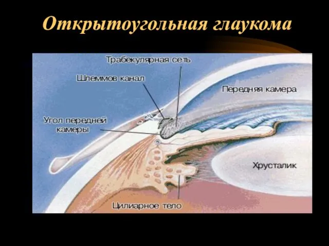 Открытоугольная глаукома