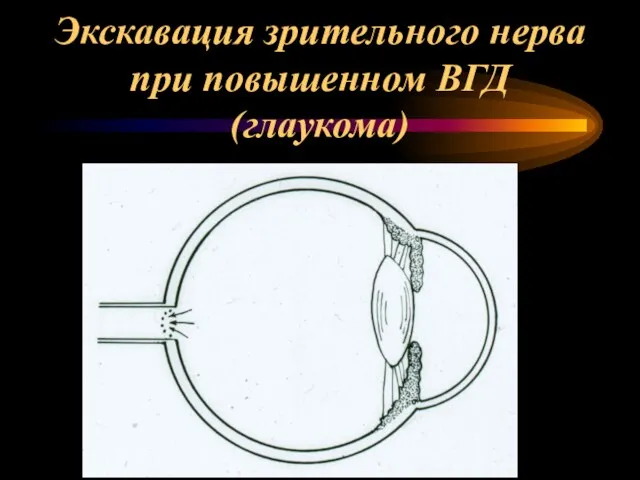 Экскавация зрительного нерва при повышенном ВГД (глаукома)