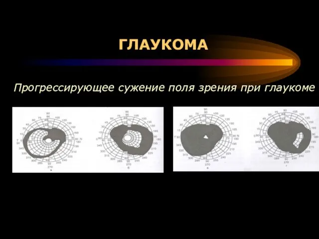 ГЛАУКОМА Прогрессирующее сужение поля зрения при глаукоме