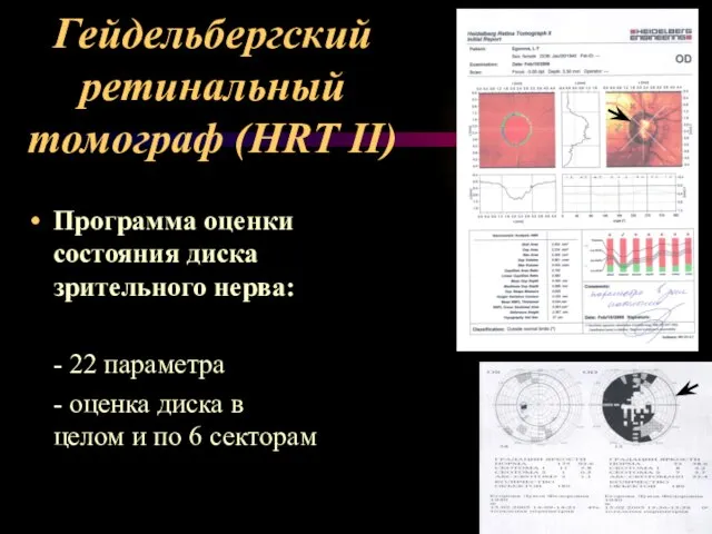 Гейдельбергский ретинальный томограф (HRT II) Программа оценки состояния диска зрительного нерва: