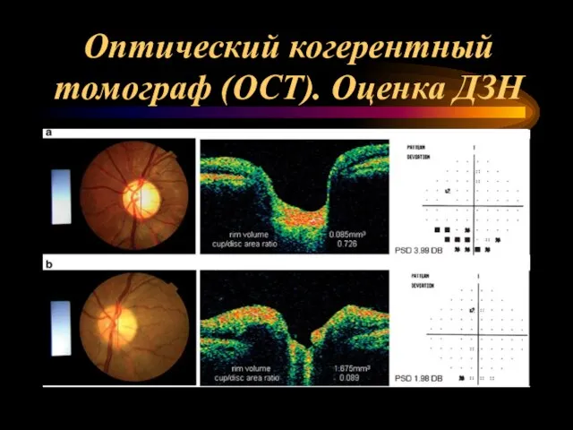 Оптический когерентный томограф (OCT). Оценка ДЗН