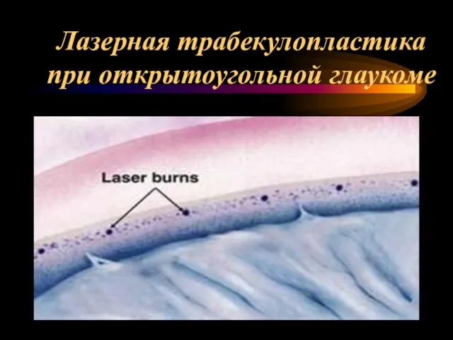Лазерная трабекулопластика при открытоугольной глаукоме