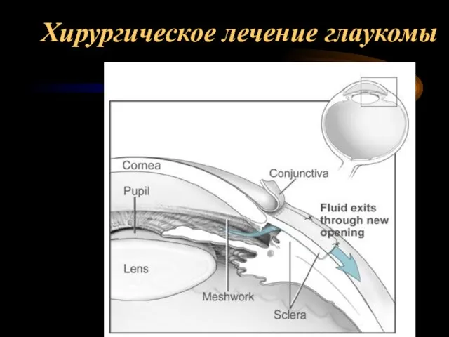 Хирургическое лечение глаукомы