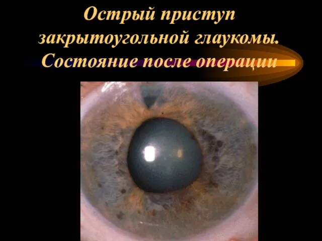 Острый приступ закрытоугольной глаукомы. Состояние после операции