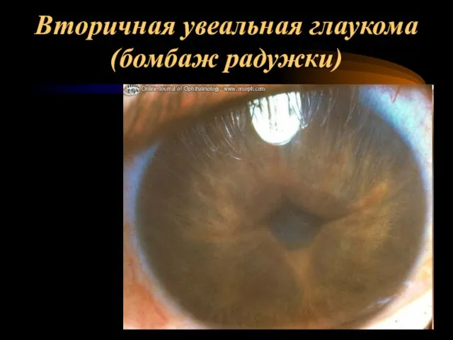 Вторичная увеальная глаукома (бомбаж радужки)