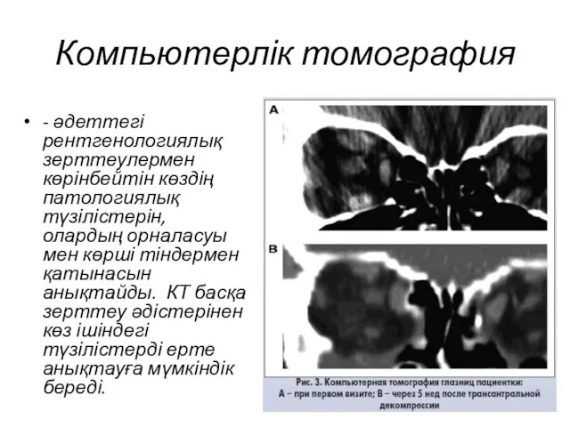 Компьютерлік томография - әдеттегі рентгенологиялық зерттеулермен көрінбейтін көздің патологиялық түзілістерін, олардың