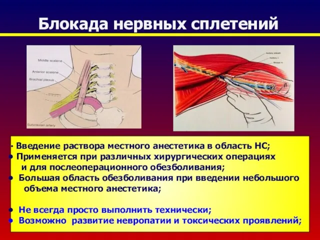 Блокада нервных сплетений Введение раствора местного анестетика в область НС; Применяется