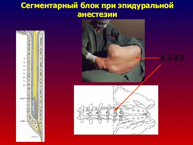 Сегментарный блок при эпидуральной анестезии L3/4/5