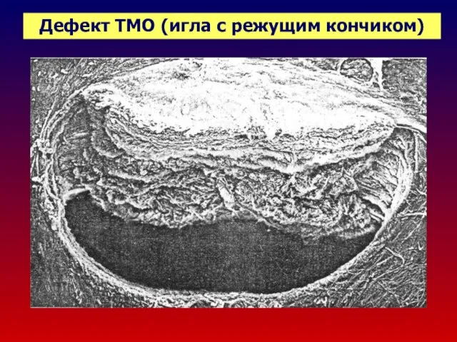 Дефект ТМО (игла с режущим кончиком)