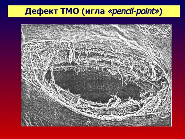 Дефект ТМО (игла «pencil-point»)