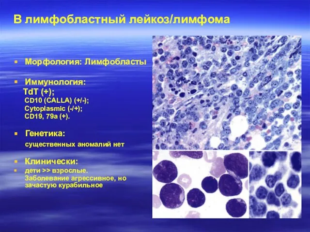 B лимфобластный лейкоз/лимфома Морфология: Лимфобласты Иммунология: TdT (+); CD10 (CALLA) (+/-);