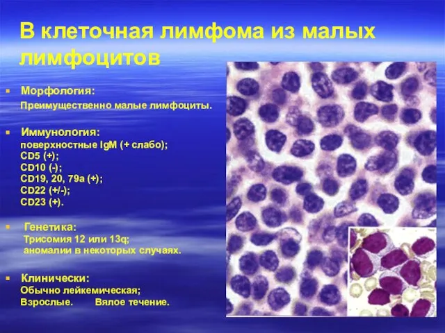 B клеточная лимфома из малых лимфоцитов Морфология: Преимущественно малые лимфоциты. Иммунология: