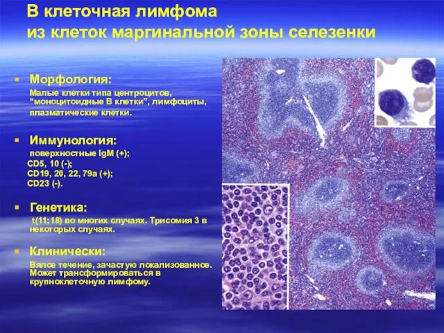 В клеточная лимфома из клеток маргинальной зоны селезенки Морфология: Малые клетки